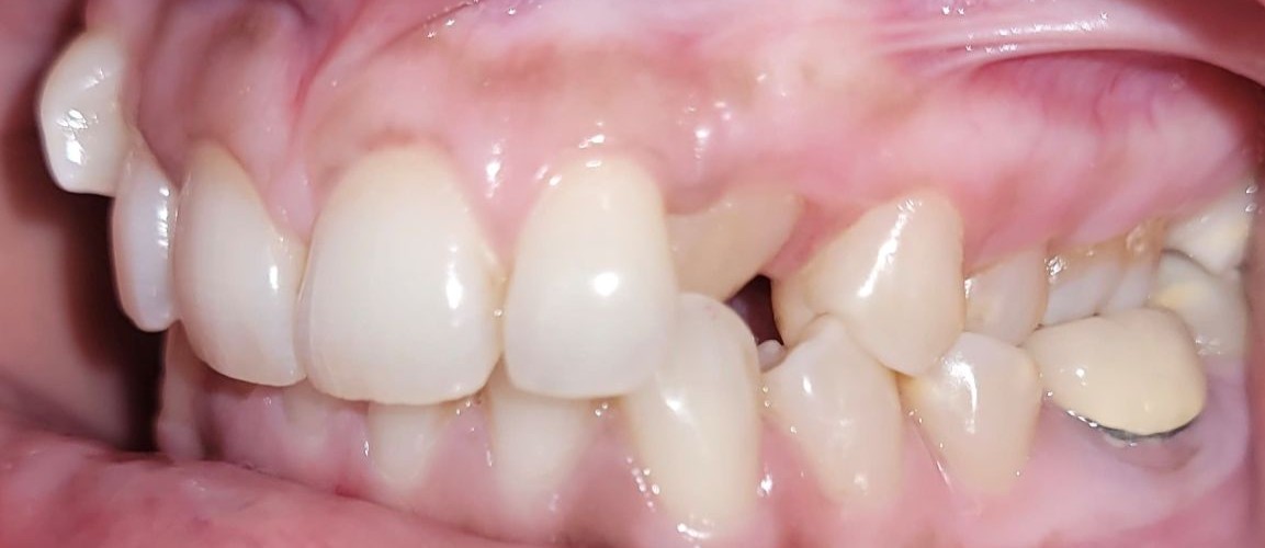 braces-1a
