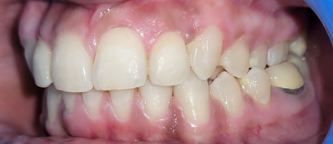 braces-1b