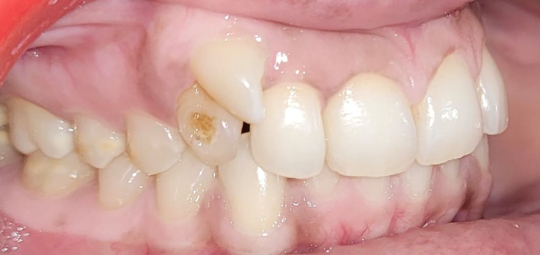 braces-1a