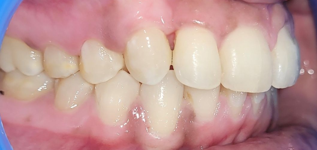 braces-1b